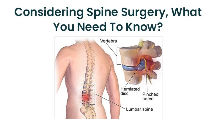 Considering Spine Surgery, What You Need To Know?