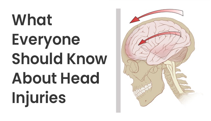 What Everyone Should Know About Head Injuries