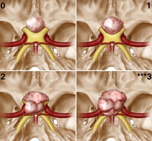 Skull-base lesions