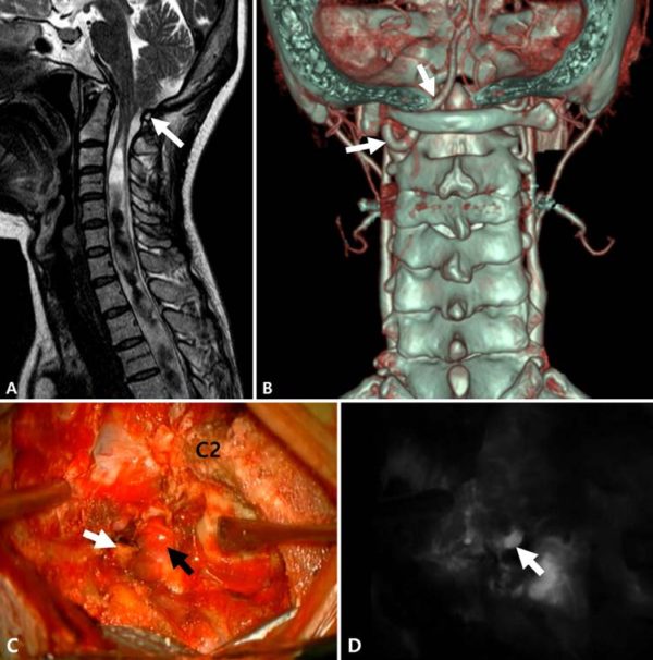 Craniovertebral Junction