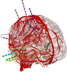 Epilepsy Surgery