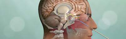 Endoscopic - Skull base surgery