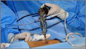 Endoscopic Spine surgery