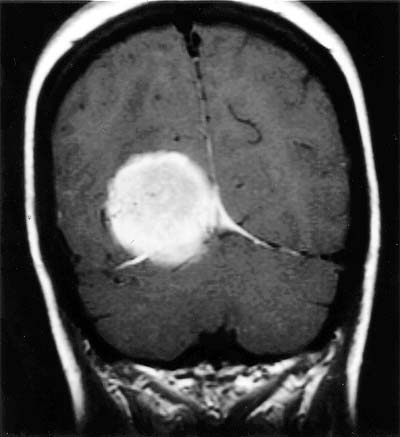 Neuropathology