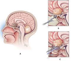 Endoscopic Brain & Spine surgery