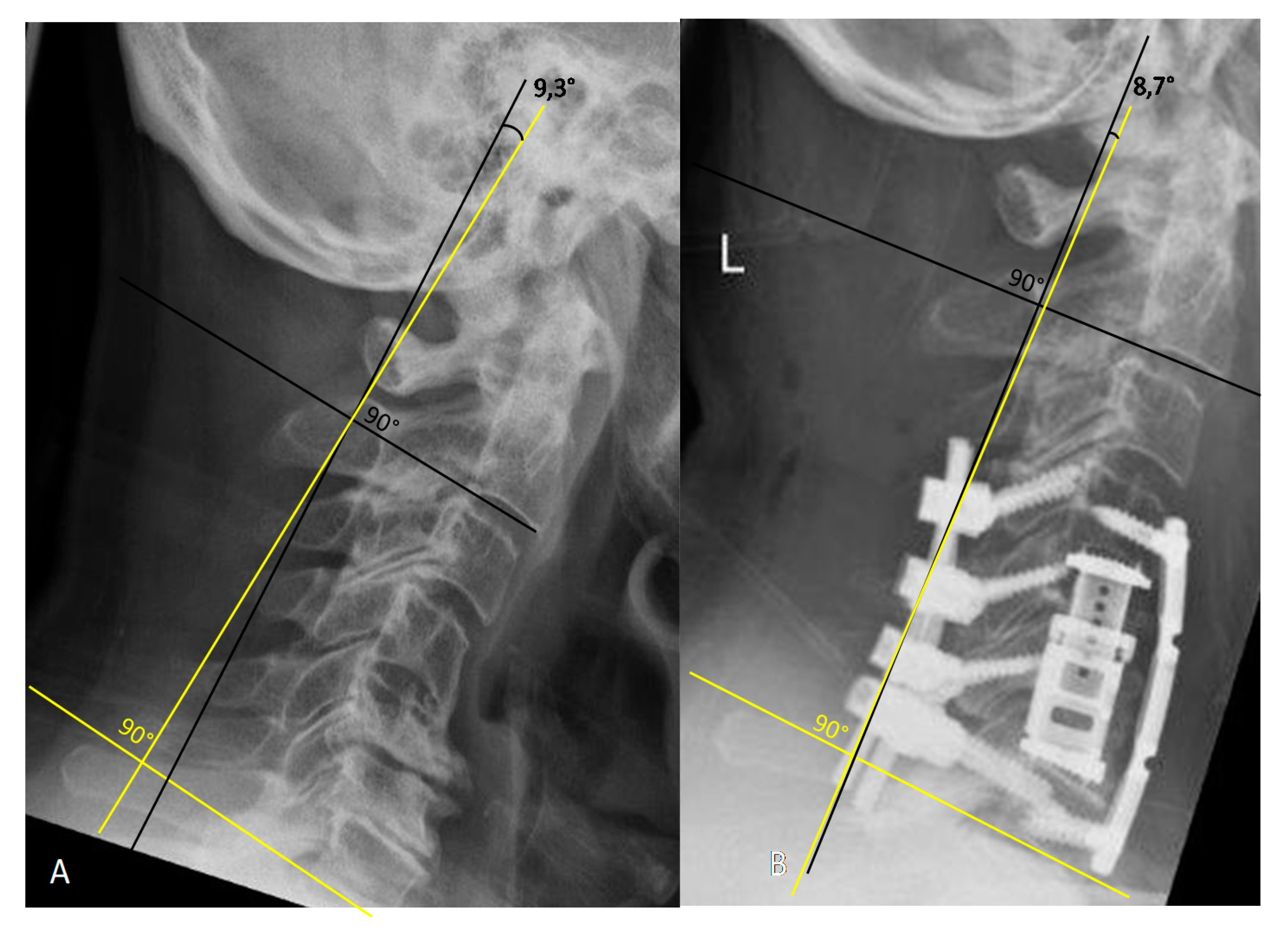 Spine - CVJ and Subaxial Cervical spine